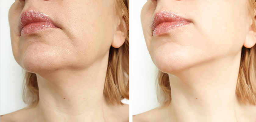 Why is Facelift in Turkey the Best?