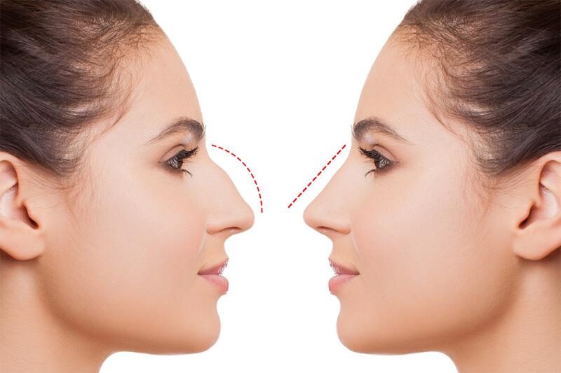 How to Book a Safe and Affordable Rhinoplasty in Turkey – Step-by-Step Guide | Zeoby