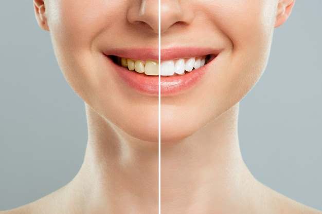 Skin Whitening Treatments in Turkey – Safe, Effective & Affordable | Zeoby