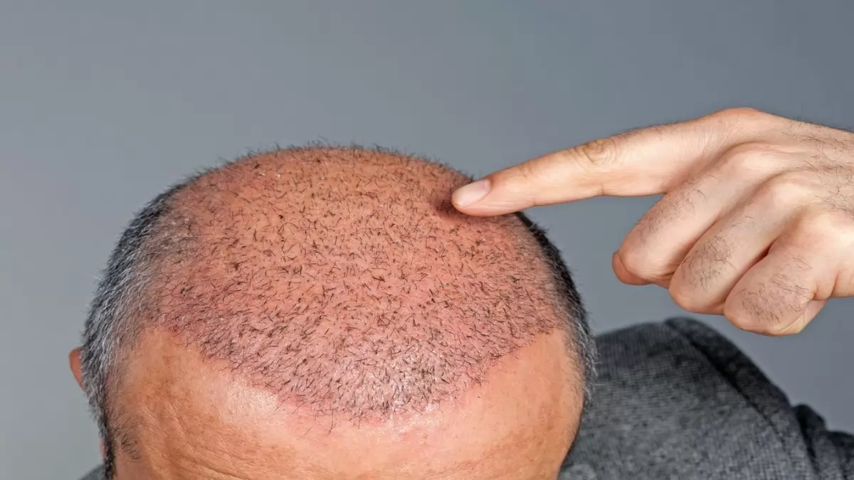 Hair Transplant in Turkey – Cost, Techniques & What to Expect in 2025