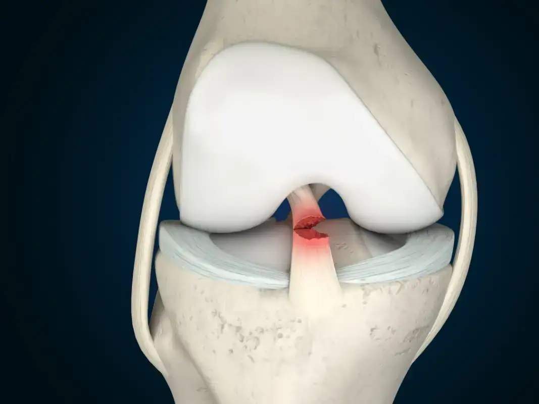 ACL Surgery in Turkey – Cost, Procedure & Recovery in 2025 | Zeoby