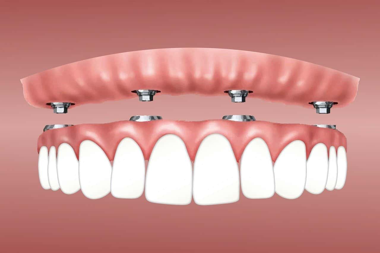 Full Mouth Dental Implants in Turkey: Everything You Need to Know | Zeoby