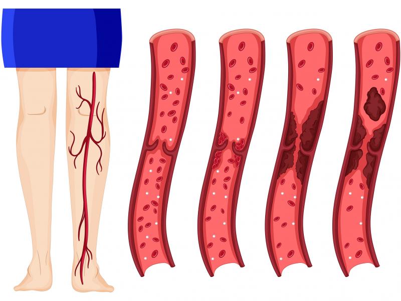 Arteriopathy Obliterans Treatment in Turkey – Cost, Options & Recovery | Zeoby