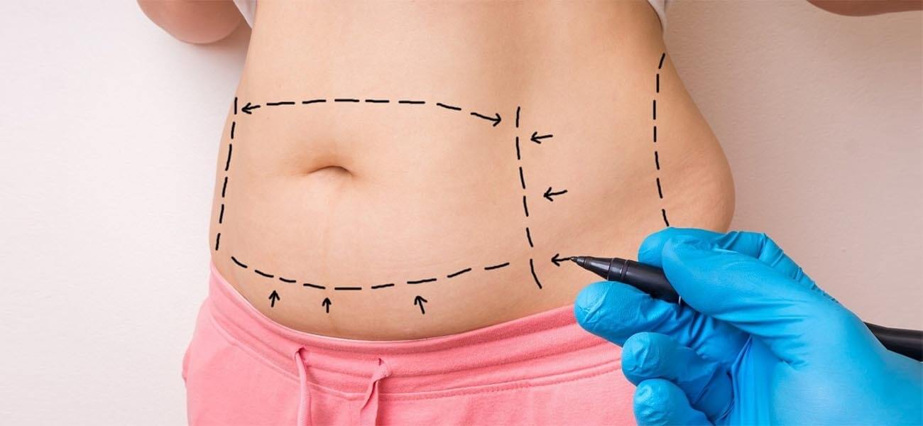 Tummy Tuck in Turkey: Cost, Recovery & Real Patient Experiences | Zeoby