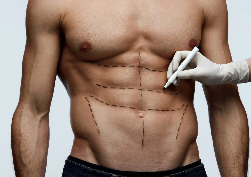 Abdominal Etching in Turkey: What to Expect, Cost & Recovery in 2025